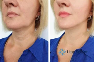 Double chin before and after Hi-Fu treatment 4 Book your double chin treatment Whitstable today! We are here to help!