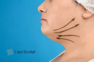Double chin before and after Hi-Fu treatment 3 Boost your confidence with a Double chin treatment Whitstable