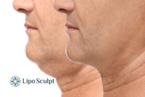 Double chin before and after Hi-Fu treatment 2 Double chin treatment Whitstable from Lipo Sculpt - feel more confident today!