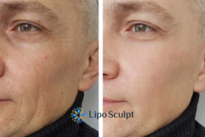 How to Fight Aging Symptoms 3 Fight Aging Symptoms Whitstable With HIFU and Morpheus8 Today!
