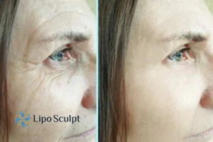 How to Fight Aging Symptoms 2 Do you want to Fight Aging Symptoms Whitstable? Contact Lipo Sculpt today!