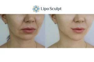 Explaining Total Skin Tightening Treatment And What It Can Do For You 2 Do you want to boost your self confidence? Give Morpheus8 Whitstable a try today!