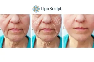 Explaining Total Skin Tightening Treatment And What It Can Do For You 3 Boost your confidence with Morpheus8 Whitstable call our team today!