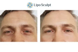 Explaining Total Skin Tightening Treatment And What It Can Do For You 6 Morpheus8 Whitstable book in today to find out more!