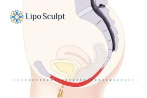 Pelvic Floor Chair Therapy 1 Pelvic Floor Chair Therapy Whitstable to treat incontinence.