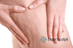 CoolSculpting for Legs: The Innovative Approach to Redefining Your Legs 5 Start your journey today book your coolsculpting treatment Whitstable online today!