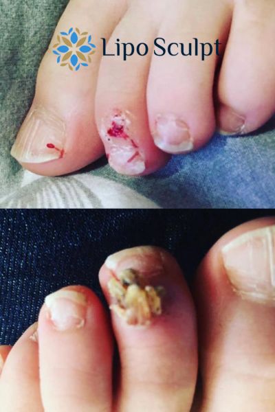 Wart removal customer results from Lipo Sculpt Whitstable
