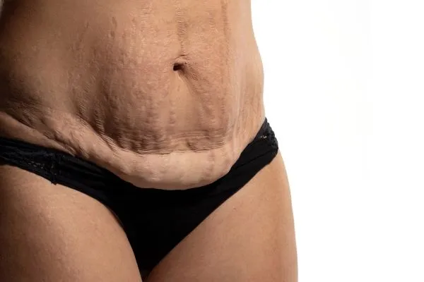 Lost the Weight but Not the Loose Skin? 1 image of womans stomach after weight loss showing loose skin Whitstable